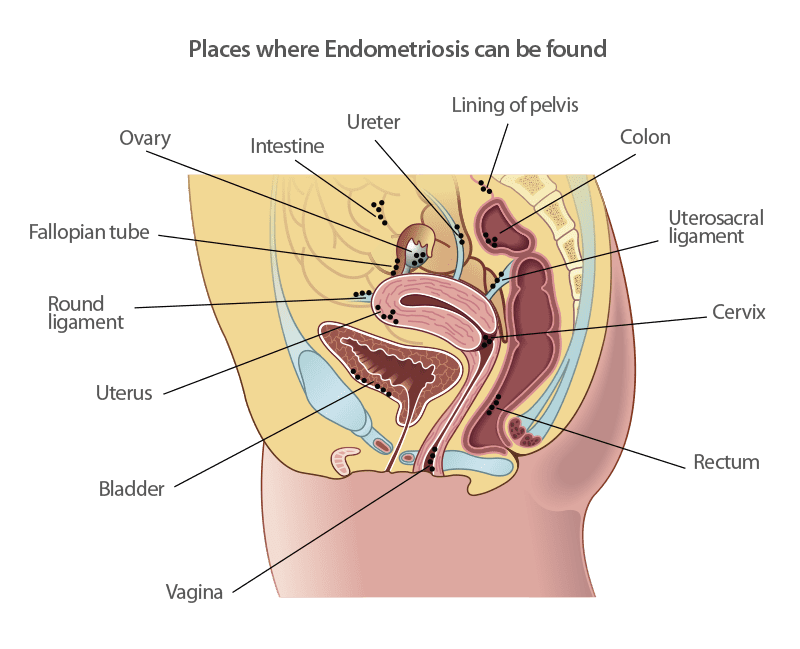 places with endometriosis