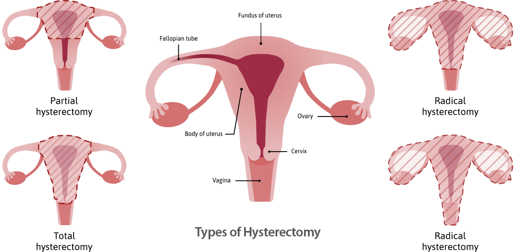 hysterectomy